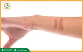 Vết Bỏng Bị Thâm Đen: Nguyên Nhân & 3 Bước Chăm Sóc Đúng Cách Để Xóa Thâm, Ngừa Sẹo