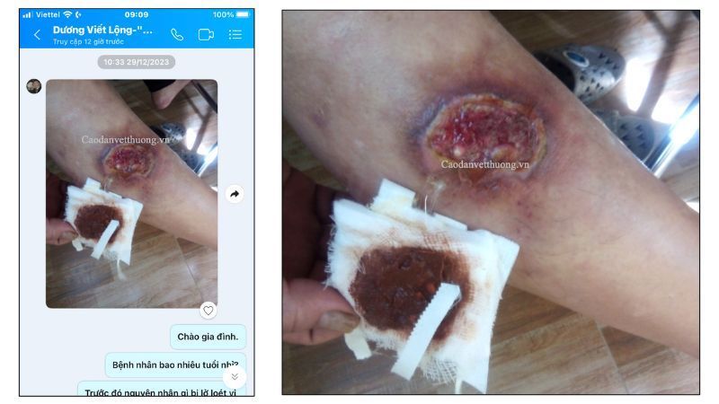 vết bỏng bô xe máy ban đầu