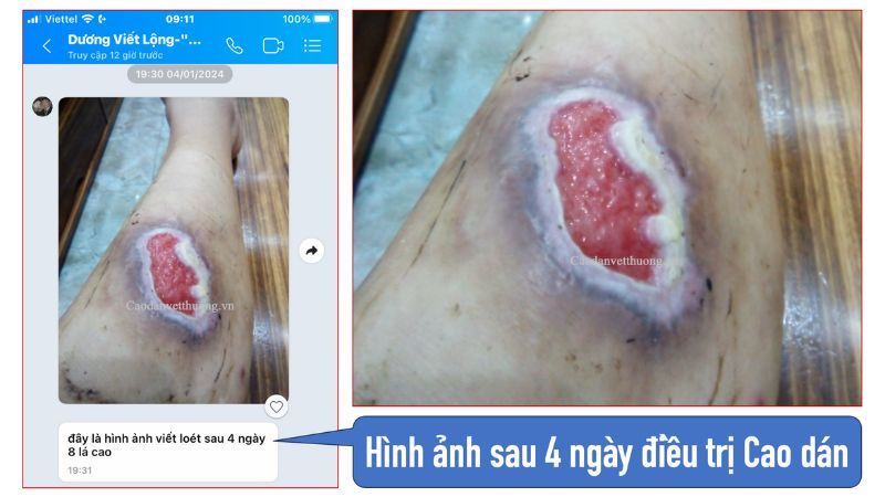 vết bỏng có dịch giai đoạn đầu