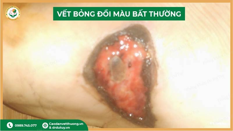 vet-bong-doi-mau-hoai-tu