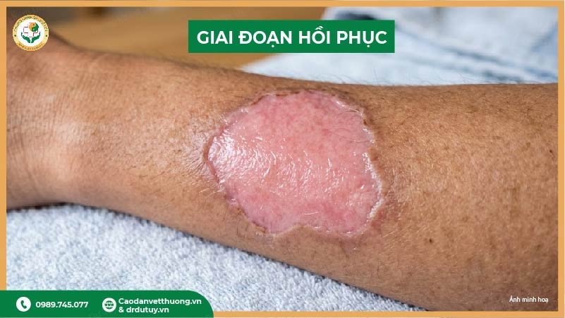 vết bỏng hơi phục hồi da non