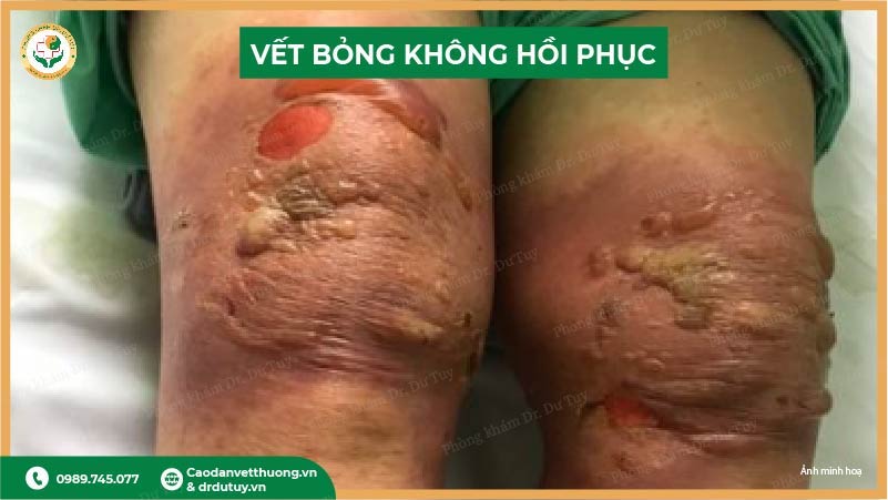 vet-bong-khong-hoi-phuc