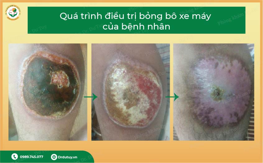 vết bỏng lâu lành
