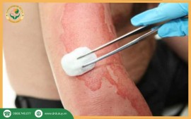 Vết Bỏng Lâu Lành Có Sao Không? Dấu Hiệu Tránh Biến Chứng Nhiễm Trùng