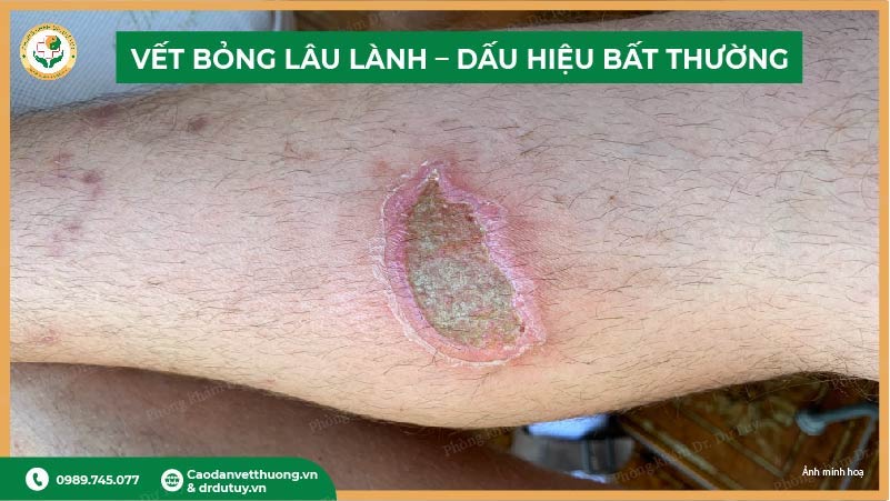 vết bỏng lâu lành dấu hiệu bất thường