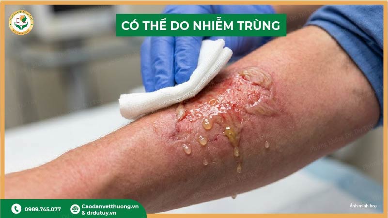 vết bỏng nhiễm trùng có mủ