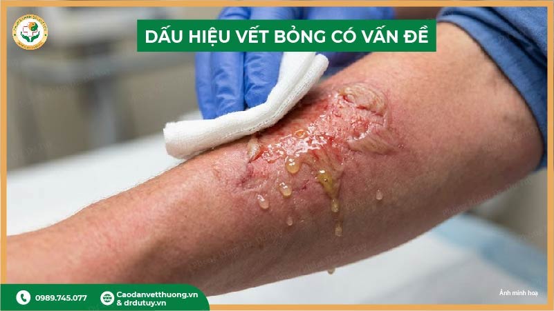 vết bỏng nhiễm trùng sau 5 ngày
