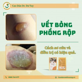 Vết bỏng phồng rộp nên điều trị như thế nào?