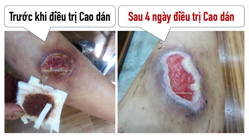 vết bỏng sau 4 ngày