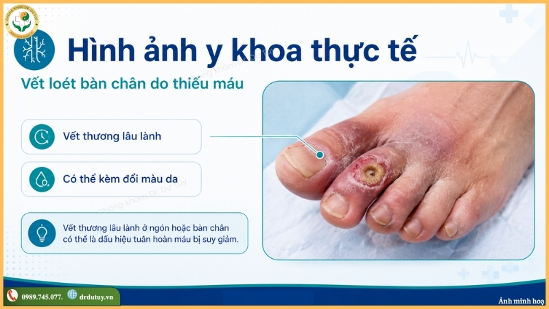vet-loet-ban-chan-do-thieu-mau