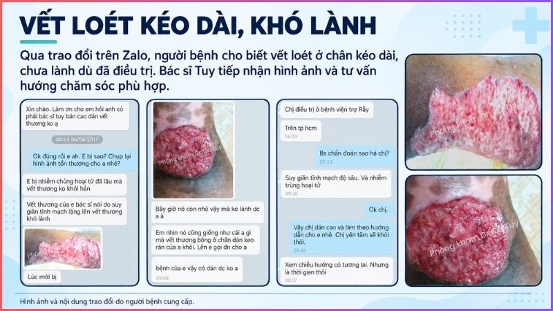 vet-loet-co-chan-keo-dai-kho-lanh