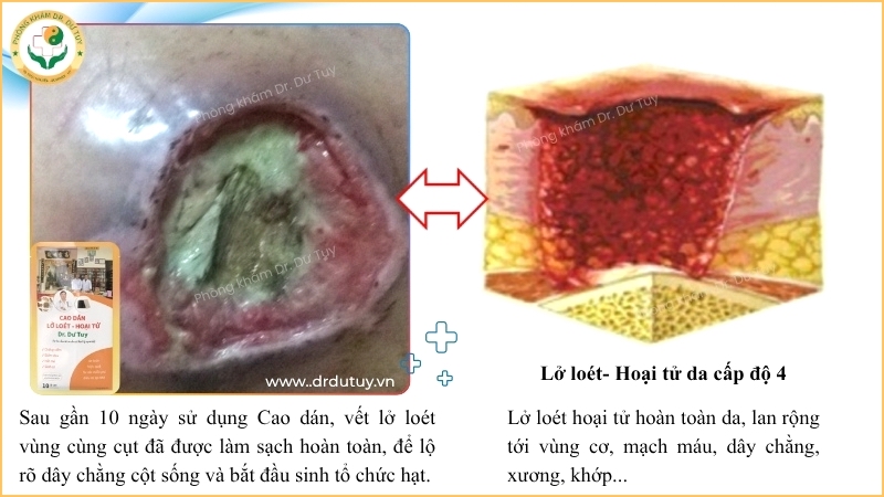vet-loet-cung-cut-sau-10-ngay-dung-cao-dan-dr-du-tuy