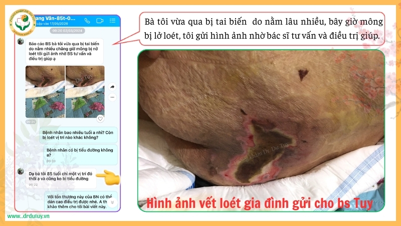 vết loét da ở người già nằm lâu vùng cùng cụt