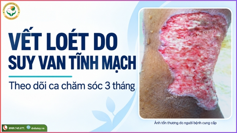 vet-loet-suy-van-tinh-mach-theo-doi-3-thang
