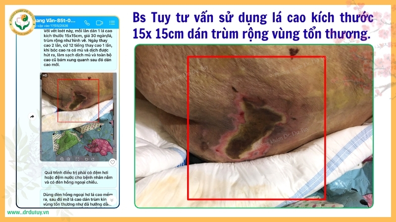 vết loét tì đè vùng cùng cụt ở người già