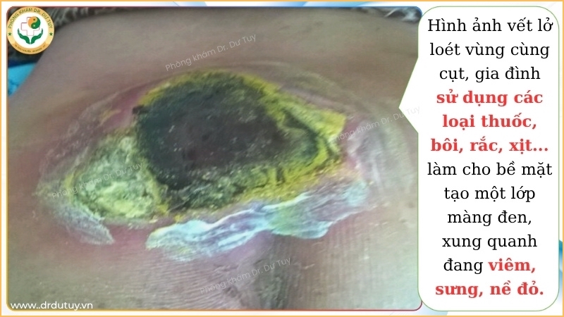 vet-loet-vung-cung-cut-viem-sung-do-dung-thuoc-sai