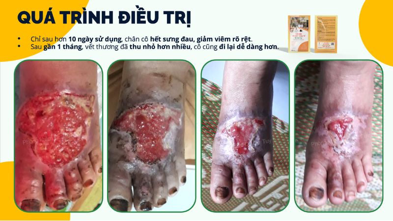 vet-thuong-ban-chan-da-lanh-hoan-toan-sau-1-thang