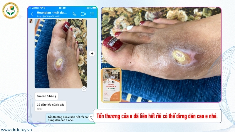 vet-thuong-ban-chan-lien-tot-sau-dung-cao-dan