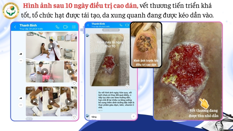 vết thương cẳng chân sau 10 ngày chăm sóc