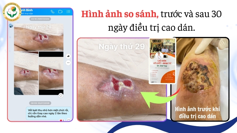 vết thương cẳng chân trước và sau 30 ngày