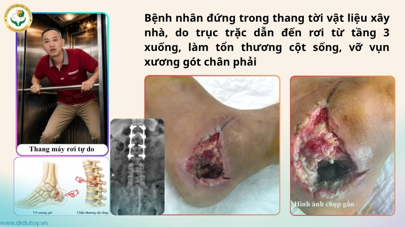 vet-thuong-got-chan-sau-tai-nan-roi-thang-tu-tang-3