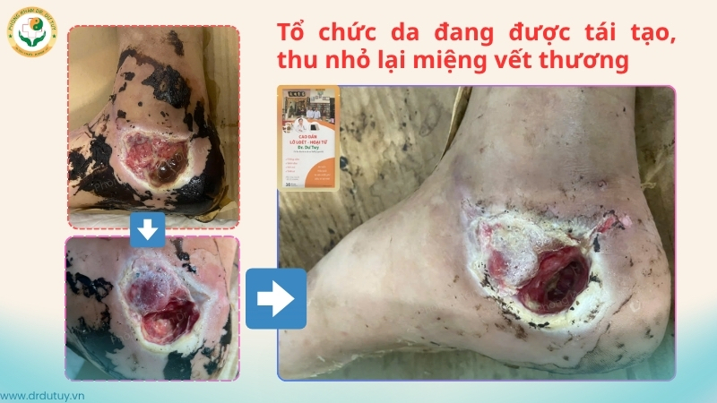 vet-thuong-got-chan-sinh-to-chuc-hat-thu-nho-mieng-thuong