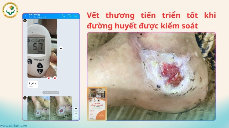 vet-thuong-got-chan-tien-trien-tot-khi-duong-huyet-on-dinh