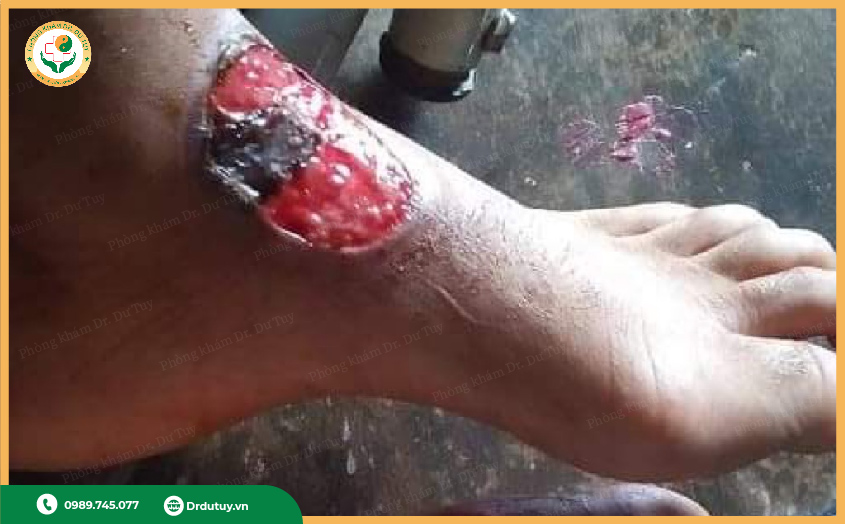 vet-thuong-khong-lanh