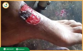 Nguy Cơ Nhiễm Trùng Cao Từ 5 Sai Lầm Khi Chăm Sóc Vết Loét Tại Nhà