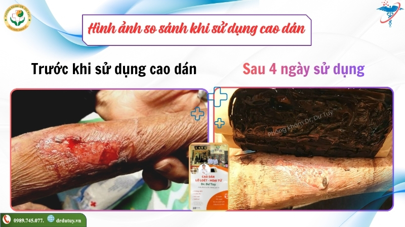 vet-thuong-mat-da-truoc-sau-4-ngay