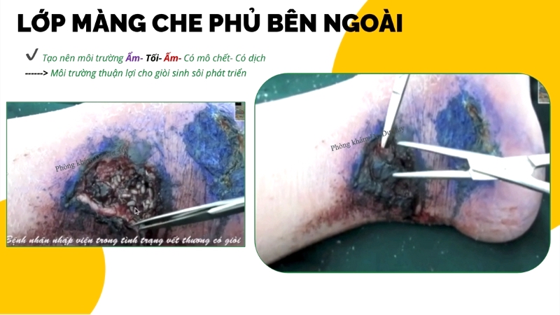 vet-thuong-nhiem-gioi-myiasis-nang