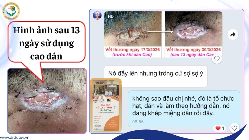vet-thuong-sau-13-ngay-su-dung-cao-dan