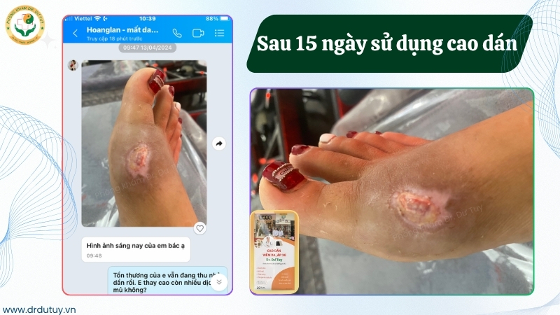 vet-thuong-sau-15-ngay-su-dung-cao-dan