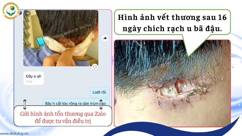 vet-thuong-sau-16-ngay-chich-rach-u-ba-dau
