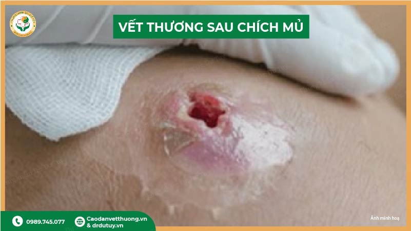 vet-thuong-sau-chich-mu-ap-xe