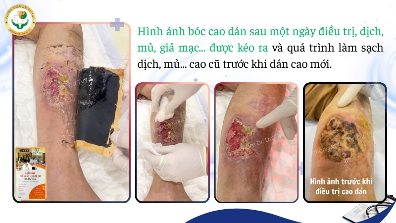 vết thương sau một ngày sử dụng cao dán