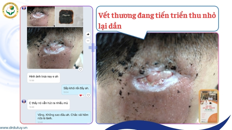 vet-thuong-vung-gay-thu-nho-dan-khi-dan-cao