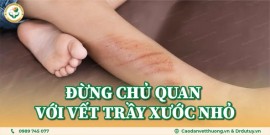 Vết trầy xước nhỏ cũng có thể gây viêm, loét da