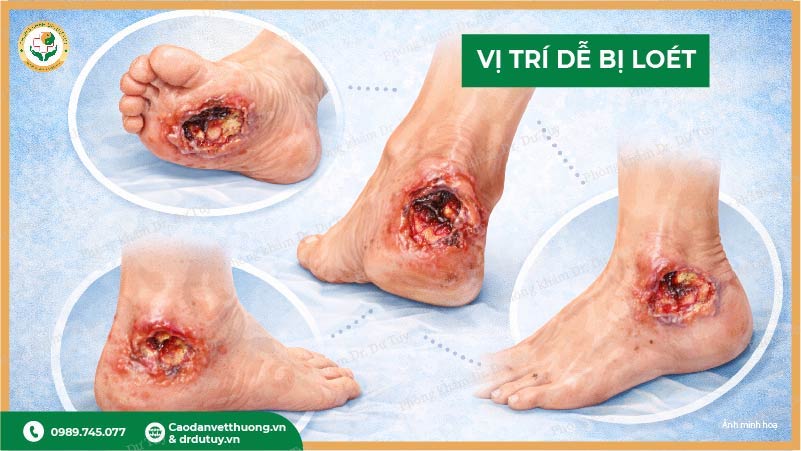 vi-tri-de-bi-loet-ban-chan-tieu-duong