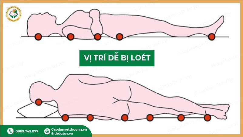 vi-tri-de-bi-loet-ti-de(1)