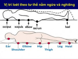 Vị trí loét tì đè thường xuất hiện ở người bệnh nằm liệt