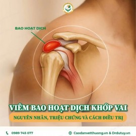 Viêm bao hoạt dịch khớp vai