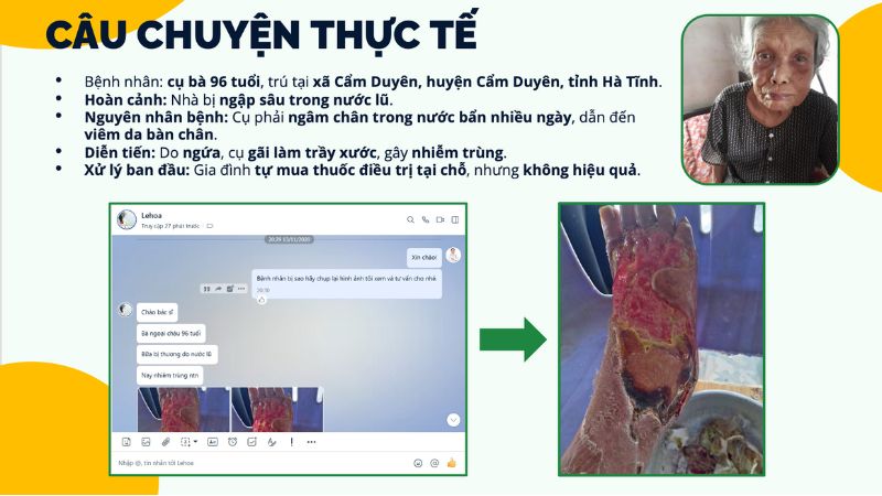 viêm chân tay