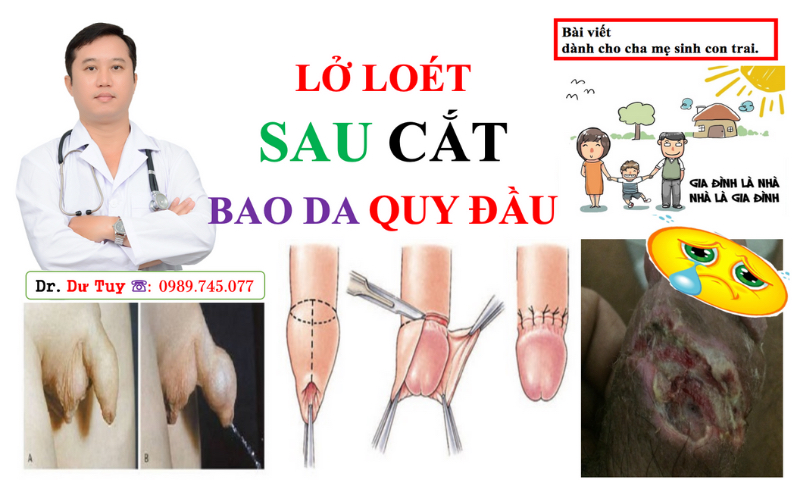 viêm loét bộ phận sinh dục nam