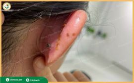 Điều Trị Viêm Sụn Vành Tai Không Cần Chích Rạch – Giải Pháp An Toàn Từ Cao Dán Dr. Dư Tuy 