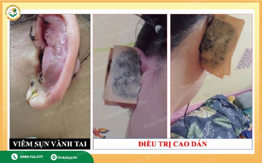 viem-sun-vanh-tai(5)