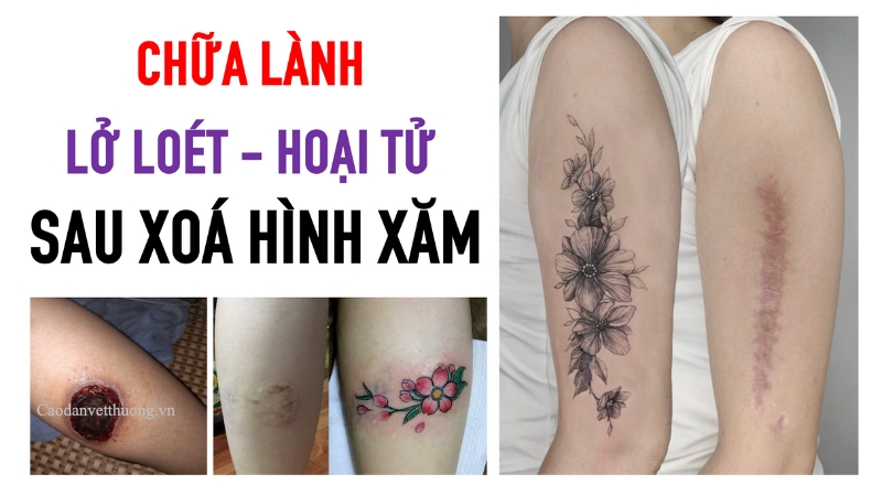 Xoá hình xăm ở đâu