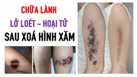 Chữa lành lở loét da sau xoá hình xăm