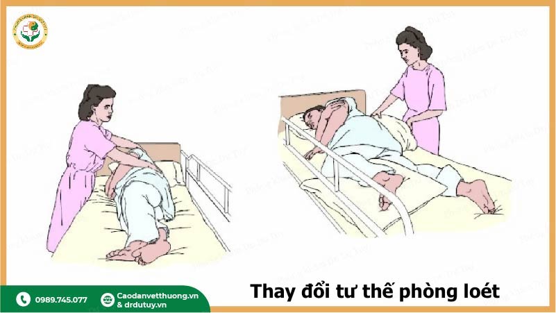 xoay-tro-benh-nhan-phong-loet