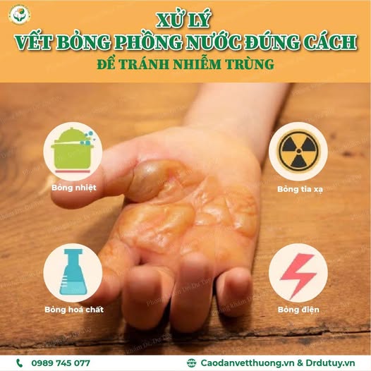 xu-ly-vet-bong-bi-phong-nuoc-dung-cach-de-tranh-nhiem-trung
